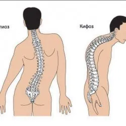 гръбначния стълб кифоза - отколкото е опасно и как да се отнасяме скалпел - Медицински