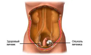 Clasificarea și simptome de tumori ovariene benigne