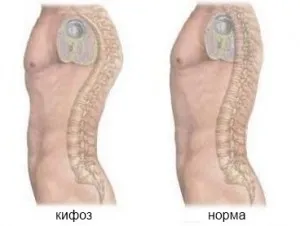Кифозата на гръбначния стълб причинява, диагностика и лечение (видео)