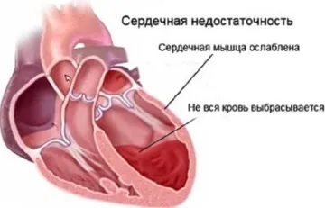 Clasificarea insuficienta cardiaca acuta - gradul de severitate al bolii