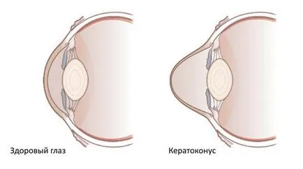 лечение кератоконус и разходите за експлоатация