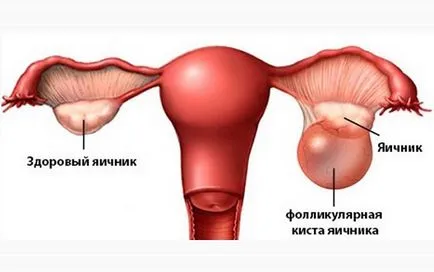 Киста на яйчниците лечение или операция