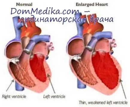 Clasificarea insuficienta cardiaca acuta - tratament de inima