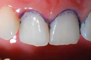 Színezékek kimutatására foglepedék - Dental Journal istom