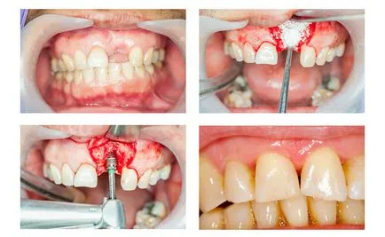 Csontpótlás fogászati ​​implantátumok