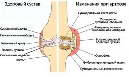 Gyógytorna, gyakorlatok, gyakorlatokat gonarthrosis