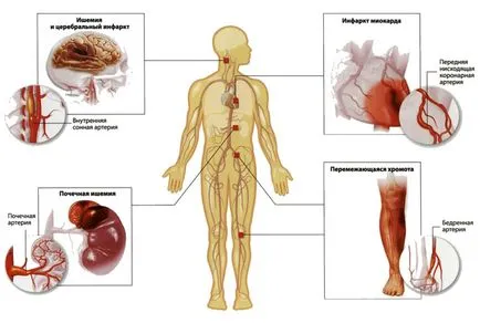 Ateroszklerózis kezelése homeopátiával