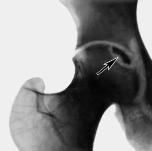 Tratamentul de osteonecroză a șoldului, a genunchiului și a maxilarului