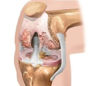 Terapia Exercitarea in osteoartrita a genunchiului elimina cauzele si simptomele bolii