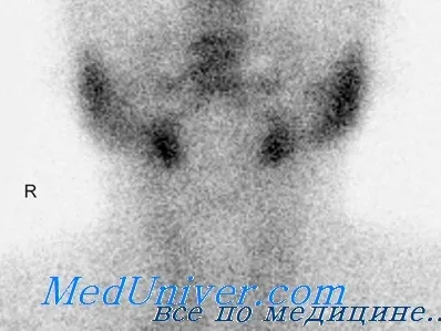 tratamentul gușei toxic cu iod radioactiv și eficacitatea acestuia