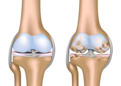Terapia Exercitarea in osteoartrita a genunchiului elimina cauzele si simptomele bolii