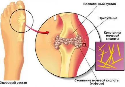 köszvény kezelésére alatt fellángolások, mint a gyógyítás, kezelés otthon, rehabilitáció