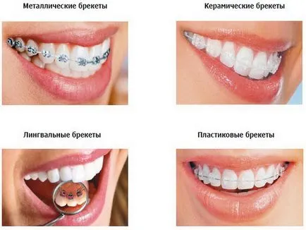 Többnyelvű fogszabályozó alkalmazás típusok brekitov
