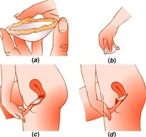 diafragma vaginal contraceptiv