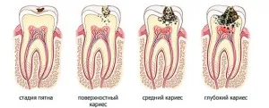 Дали кариес смърди