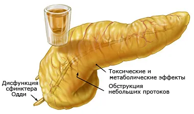 Ефектите на алкохол върху панкреаса 1