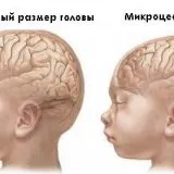 Микроцефалия клиника, диагностика, лечение - скалпел - медицинска информация и образование