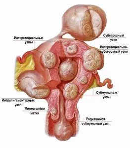 Fibroamele în timpul sarcinii