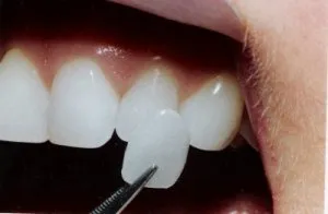 зъбни Методи за възстановяване