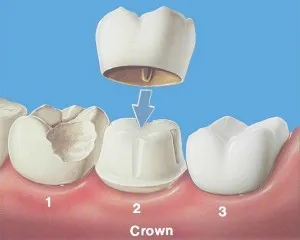 зъбни Методи за възстановяване