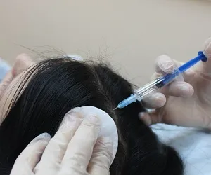 Mezoterapie pentru comentarii păr, fotografii înainte și după, indicații și contraindicații