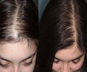 Mezoterapie pentru comentarii păr, fotografii înainte și după, indicații și contraindicații