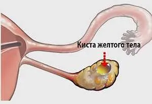 Може разтвори кисти на яйчниците и какви видове не могат да бъдат лекувани