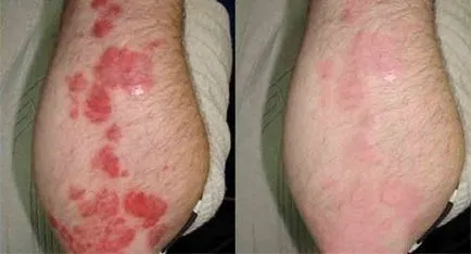 Nano Gel psoriasis véleménye, ára a gyógyszertárakban megvásárolható, útmutató, struktúra