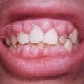 Nu-ți face griji, dinți, cauzele zadarnice și tratarea dinților sensibili