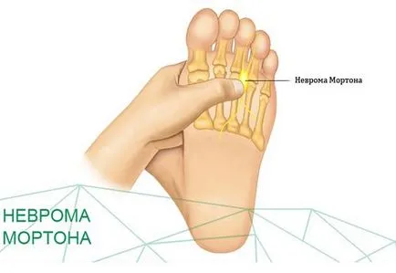 Neuroma Morton idegdaganat a láb vagy a diagnózis és a kezelés