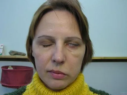 Nevrotice simptome nervoase facial și tratament distins de nevrite