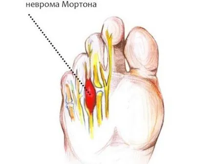 неврома на крака или диагностиката и лечението неврома на Мортън