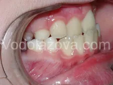 Tratamentul ortodontic copiilor