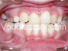 Tratamentul ortodontic copiilor