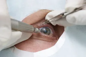 Операцията за замяна на очите на очната леща катаракта, възстановяване