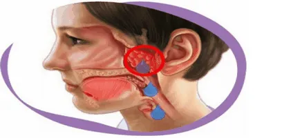 Усложнения от adenoiditis загуба на слуха в аденоиди