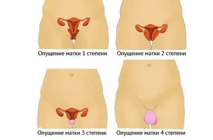 Пропускането на матката, която направи предизвика косопад лечения