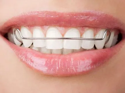 Ортодонтски уреди класификация и видове модерни системи в ортодонтия