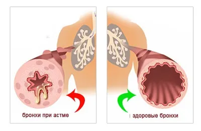 Akut bronchitis gyermekeknél a tünetek, okok és kezelés