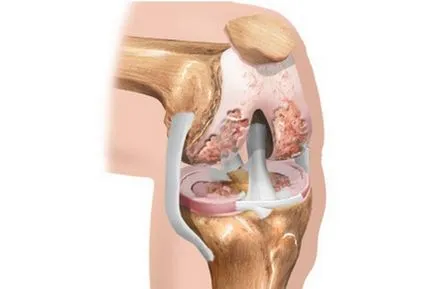 térdízület osteochondrosis