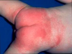 Pelenka dermatitis - kezelésére pelenka dermatitis fotó