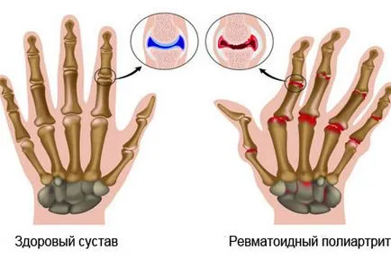 simptomele artritei și tratamentul articulațiilor, dieta