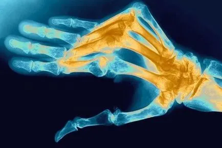 Arthritis tünetek és a kezelés az ízületek, diéta