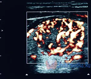 A posztoperatív hypoparathyreosis tünetei és kezelése