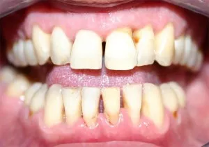 Причини и симптоми на атрофия на венците лечения