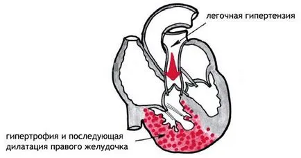 Preponderența potențialului normei ventriculului stâng sau patologie