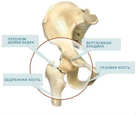 Причини и клиничната картина на фрактура на бедрената кост - основната опасност от нараняване