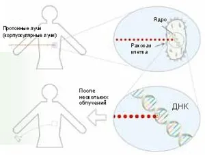 Terapia Proton pentru cancer - în România