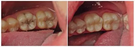 Amvon - cauze, simptome si prevenirea pulpitei dintelui