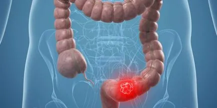 cancer de colon sigmoid precoce simptome, prognosticul, etapa